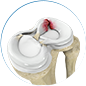 meniscus injuries by Dr. McCarthy