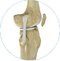 collateral ligament repair/reconstructions by Dr. McCarthy