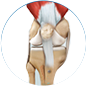 patella instability treatment by Dr. McCarthy